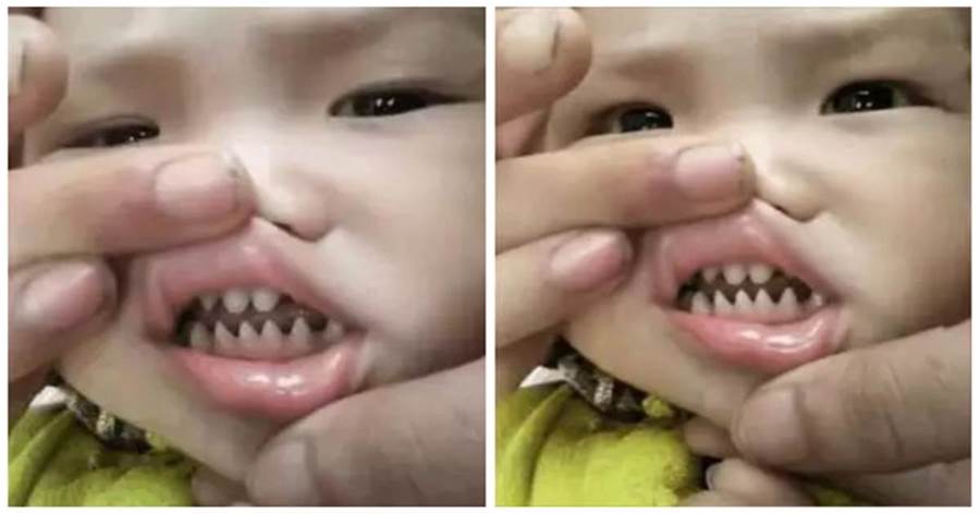 5歲寶寶長了「滿嘴鯊魚牙齒」寶媽PO照被笑：你兒子有貴族血統！網友卻說：這父母太缺德！